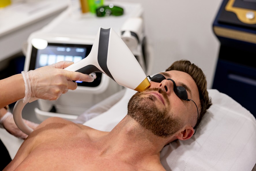 Homem recebe o procedimento de depilação a laser em sua barba