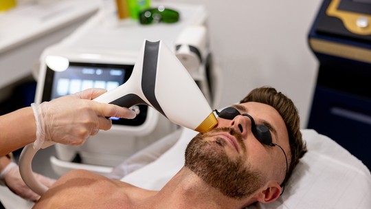 Como funciona a depilação a laser na barba