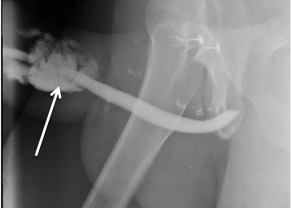 Radiografia do acidente: fraturas atingiram corpos cavernosos do pênis — Foto: Reprodução / International Journal of Surgery Case Reports
