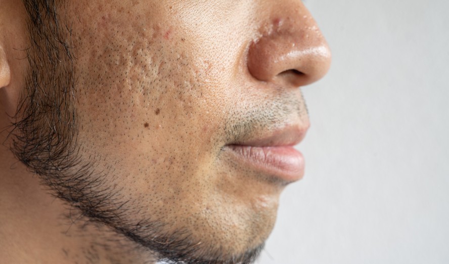 Homem com cicatrizes de acne na bochecha