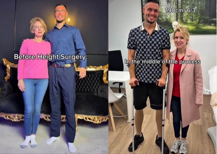 De 1,71 a 1,95m: influenciador se submete a cirurgia que envolve ...