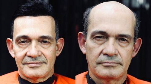 Custando até R$ 3 mil, prótese capilar vira alternativa ao implante entre homens