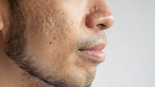 Como suavizar cicatrizes de acne