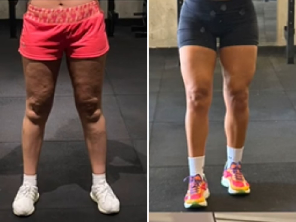 Fotos De Celulite De Kim Kardashian Antes E Depois