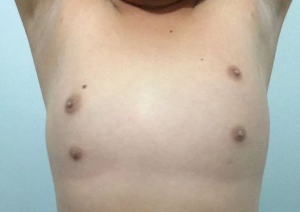Exemplo de um caso de polimastia, ou surgimento de mamas e aréolas extras no corpo — Foto: Reprodução / Mastology.org