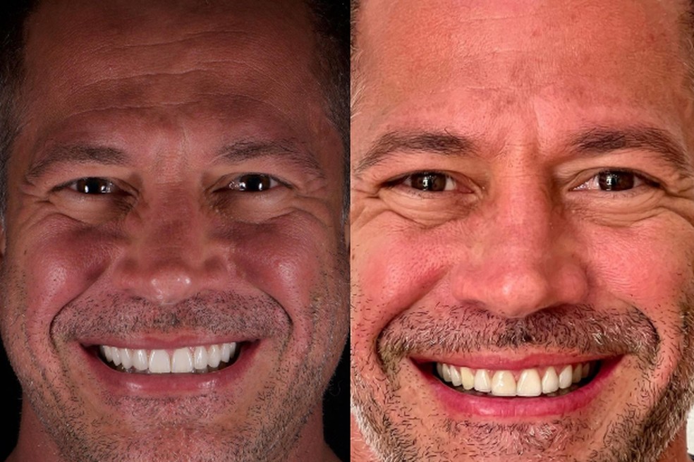 Antes e depois do Malvino Salvador — Foto: Reprodução / Instagram