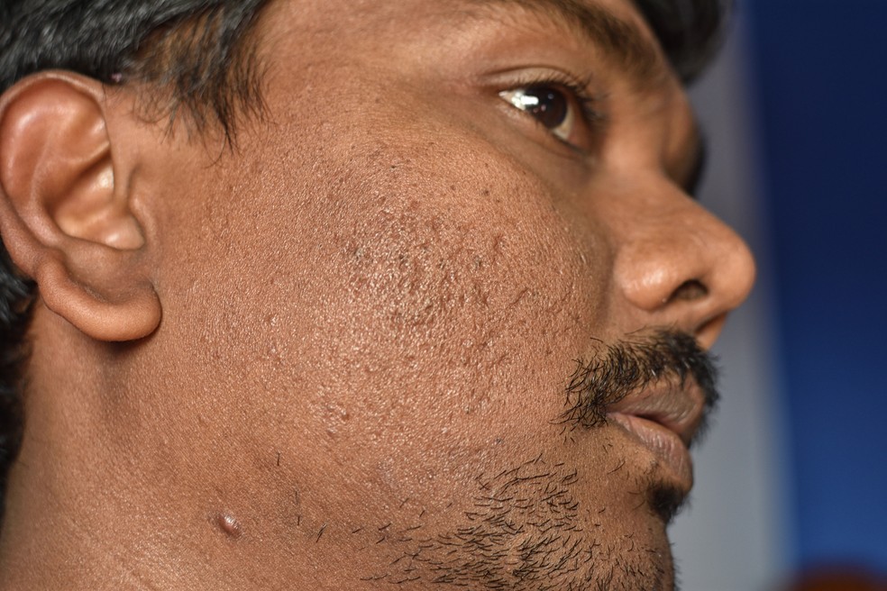 Pesquisadores focam em três fatores de risco para cicatrizes de acne — Foto: Getty Images