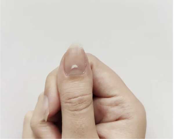 Ondulações e 'estrias' nas unhas: saiba como tratar. Unha do dedão