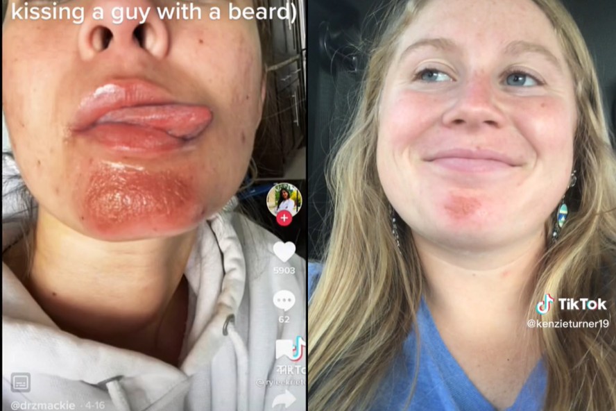 Mulheres no TikTok relatam surgimento de feridas após beijarem homens com barba